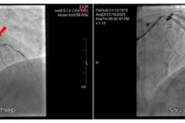 Cứu nam bệnh nhân bị nhồi máu cơ tim cấp sau 2 năm đau ngực âm ỉ