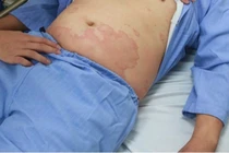 Ăn ve sầu chiên, thanh niên 26 tuổi sốc phản vệ nguy kịch