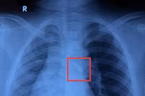 Phẫu thuật thành công lấy dị vật răng trong đường thở bé trai 10 tuổi