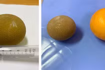 Đau bụng,... không ngờ sỏi chiếm gần hết thể tích bàng quang