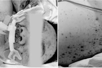 Suy gan tối cấp, suy đa tạng... vì người lớn chủ quan với thủy đậu