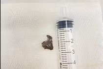 Dị vật mắc trong đường thở người bệnh 64 tuổi nhiều tháng gây ho triền miên