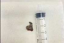 Dị vật mắc trong đường thở người bệnh 64 tuổi nhiều tháng gây ho triền miên