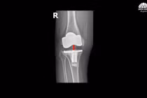 Chữa thành công biến chứng khớp gối nhân tạo hiếm gặp sau 5 năm