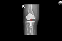 Chữa thành công biến chứng khớp gối nhân tạo hiếm gặp sau 5 năm