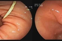 Lấy mảnh xương gà mắc kẹt trong dạ dày 4 ngày