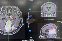 Đau đầu, giảm thị lực người phụ nữ 56 tuổi phát hiện u màng não lớn