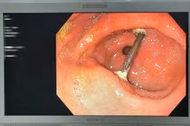 Thủng dạ dày do mảnh cây trong thuốc tự sắc