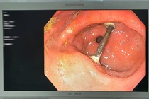 Thủng dạ dày do mảnh cây trong thuốc tự sắc