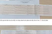 Cứu thành công bệnh nhân cơn nhịp nhanh kịch phát trên thất