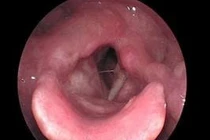 Nội soi khâu treo dây thanh cho người bệnh liệt dây thanh quản