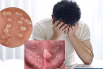 Nhận biết sùi mào gà niệu đạo, cách phòng tránh 