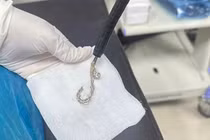 Gắp lắc bạc trong dạ dày bệnh nhi 2 tuổi