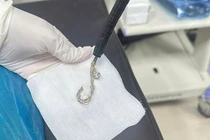 Gắp lắc bạc trong dạ dày bệnh nhi 2 tuổi