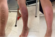 0xy cao áp hồi phục bỏng tránh sẹo lồi, sẹo co kéo cho trẻ bị bỏng