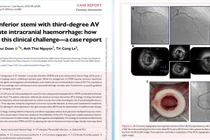 Ca bệnh hiếm gặp nhồi máu cơ tim cấp đồng thời xuất huyết não
