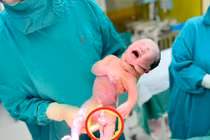 Dây rốn xoắn nhiều vòng, thai nhi thoát khỏi cửa tử nhờ bất thường hiếm gặp