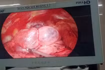 Làm chủ phẫu thuật cắt kén khí phổi ngay tại Ninh Bình