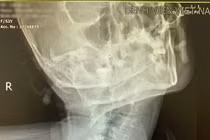 Đặt nội khí quản cho người bệnh bị vẹo cột sống cổ bẩm sinh