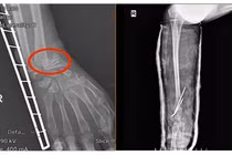 Ứng dụng kỹ thuật C-arm trong phẫu thuật xương gãy không để lại sẹo