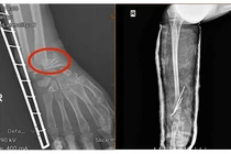 Ứng dụng kỹ thuật C-arm trong phẫu thuật xương gãy không để lại sẹo