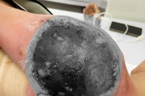 Nhiễm trùng huyết vì đắp lá chữa chấn thương vai