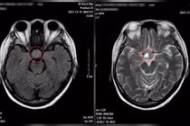 Bất thường ở mắt không ngờ u não khổng lồ
