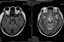 Bất thường ở mắt không ngờ u não khổng lồ