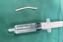 Không sờ thấy que tránh thai, phải nhập viện vì đau cánh tay