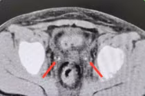 Kẹt sỏi niệu quản ở trẻ sau mổ viêm ruột thừa gây suy thận