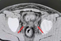 Kẹt sỏi niệu quản ở trẻ sau mổ viêm ruột thừa gây suy thận