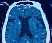 Rối loạn ý thức, suy hô hấp không ngờ nhiễm sán dây lợn