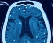 Rối loạn ý thức, suy hô hấp không ngờ nhiễm sán dây lợn