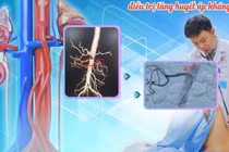 Can thiệp đặt stent động mạch thận điều trị tăng huyết áp kháng trị
