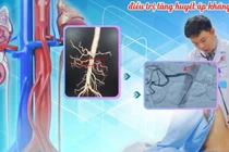 Can thiệp đặt stent động mạch thận điều trị tăng huyết áp kháng trị