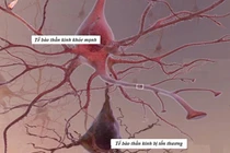 Biến chứng đa dây thần kinh ngoại biên do đái tháo đường có nguy hiểm?