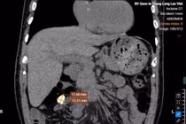 Uống nhầm thuốc sỏi thận nhiều năm, sự thật ngỡ ngàng khi chụp CT 'giải mã'