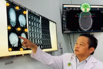 Tạo hình cho trẻ méo đầu do dính khớp sọ