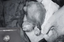 Sản phụ mang 3 khối u xơ tử cung vượt cạn an toàn nhờ phẫu thuật kịp thời