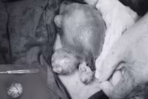 Sản phụ mang 3 khối u xơ tử cung vượt cạn an toàn nhờ phẫu thuật kịp thời