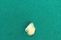 Đau, hạn chế vận động khớp cổ chân không ngờ xương mắc kẹt trong khớp