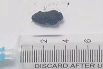 Sỏi ống mật chủ tái phát cẩn thận sốc nhiễm trùng đe dọa tính mạng