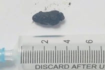 Sỏi ống mật chủ tái phát cẩn thận sốc nhiễm trùng đe dọa tính mạng