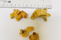 Phẫu thuật thành công lấy sỏi thận, sỏi san hô cho người bệnh