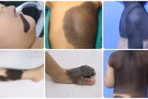 Nơ vi hắc tố bẩm sinh, dạng ung thư da ác tính nhất? 