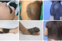 Nơ vi hắc tố bẩm sinh, dạng ung thư da ác tính nhất? 