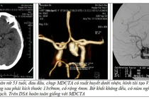 Kiểu đau đầu sét đánh nguy cơ tử vong cao 40-50%
