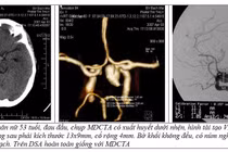 Kiểu đau đầu sét đánh nguy cơ tử vong cao 40-50%