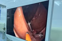 Cứu người bệnh nguy kịch do chảy máu đại tràng