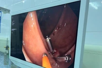 Cứu người bệnh nguy kịch do chảy máu đại tràng